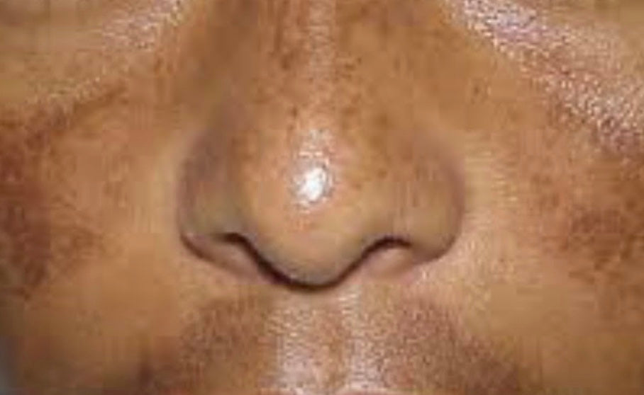 Hyperpigmentation