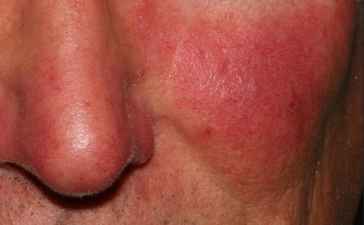 Rosacea